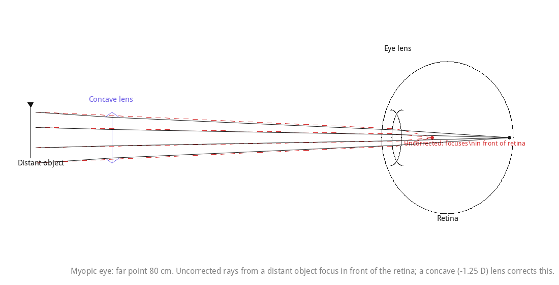 Myopic eye: far point 80 cm. Uncorrected rays from a distant object focus in front of the retina; a concave (-1.25 D) lens corrects this.