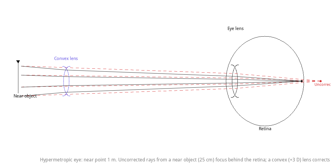 Hypermetropic eye: near point 1 m. Uncorrected rays from a near object (25 cm) focus behind the retina; a convex (+3 D) lens corrects this.