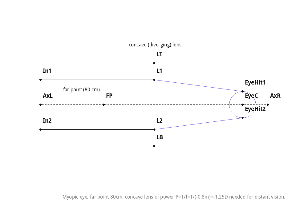 Myopic eye, far point 80cm: concave lens of power P=1/f=1/(-0.8m)=-1.25D needed for distant vision.