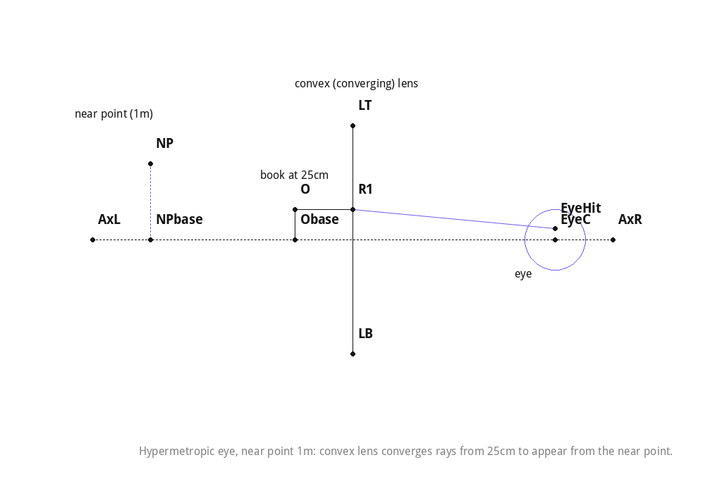 Hypermetropic eye, near point 1m: convex lens converges rays from 25cm to appear from the near point.