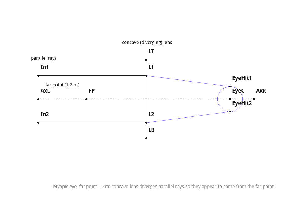 Myopic eye, far point 1.2m: concave lens diverges parallel rays so they appear to come from the far point.